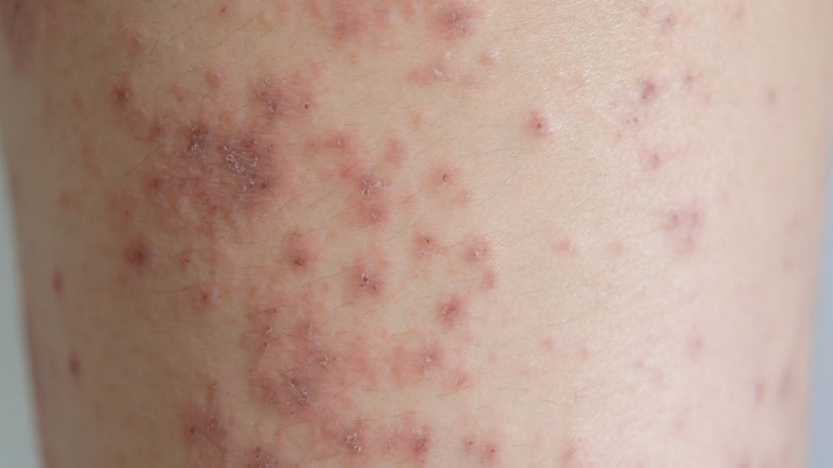 Mengenal Gejala dan Penyebab Dermopati Diabetik