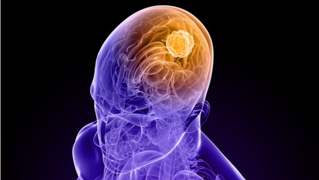 Kenali Kanker Otak dari 6 Tanda Ini