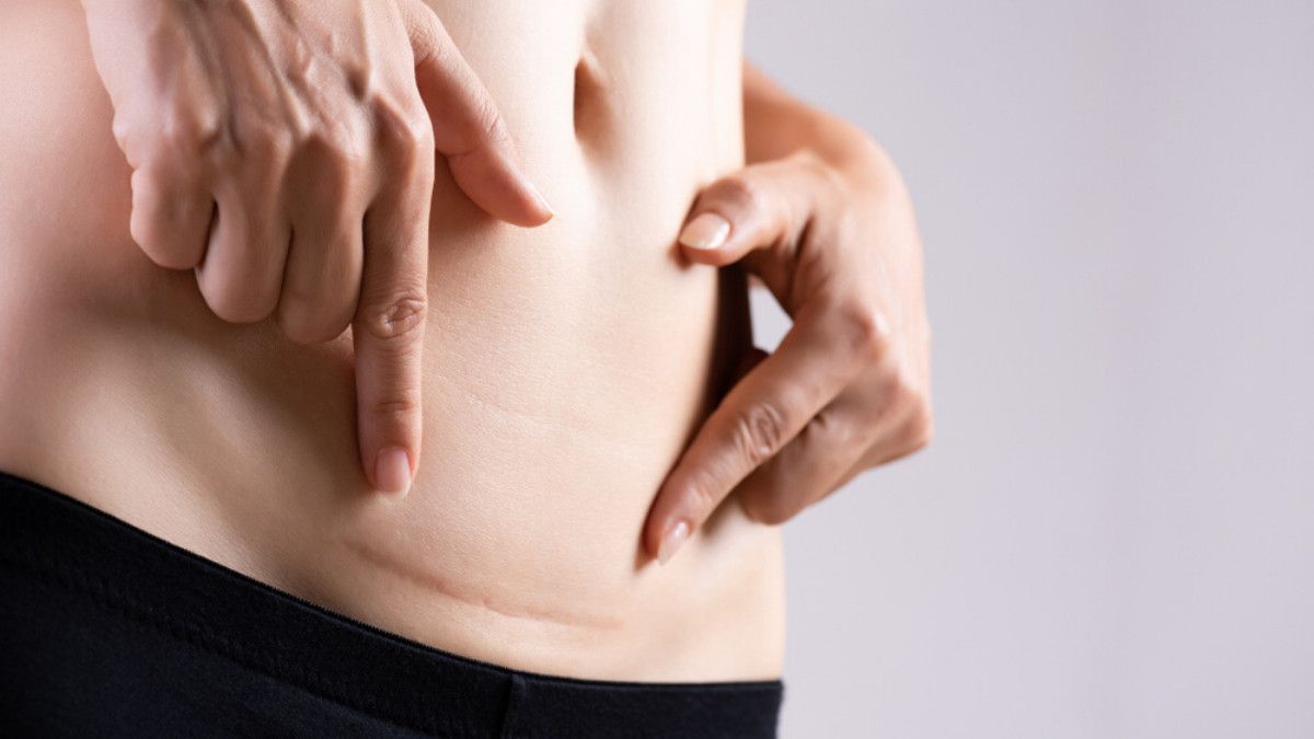 7 Tips agar Luka Operasi Caesar Cepat Kering