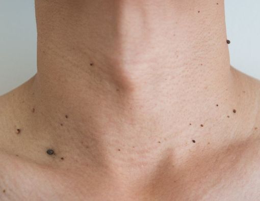 Jenis Penyakit Kulit yang Tak Bisa Sembuh Total