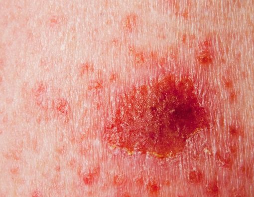 Inilah Perbedaan Kanker Karsinoma dan Sarkoma