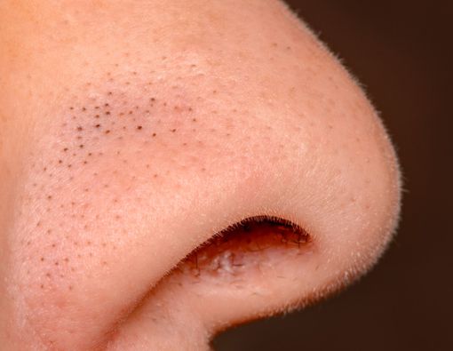 15 Cara Menghilangkan Komedo Hitam yang Efektif