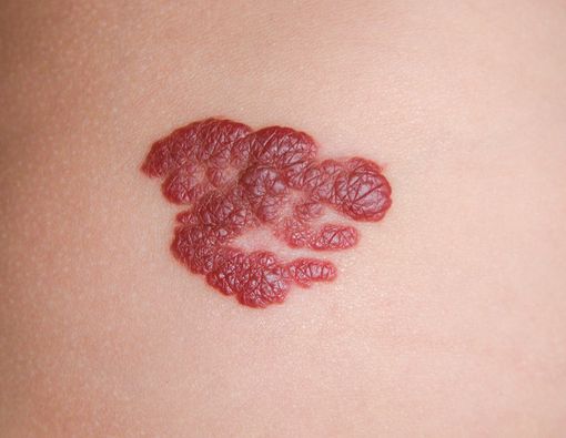 Hemangioma, Bisakah Disembuhkan?