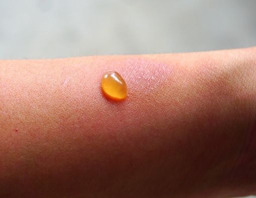 Nutrisi Penting Pencegah Kulit Lenting Lepuh atau Pemfigoid Bulosa