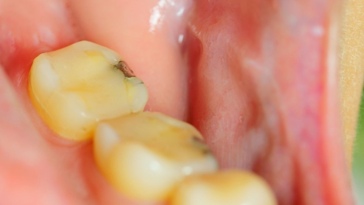 Perawatan Gigi Bercelah dengan Metode Tambal Gigi
