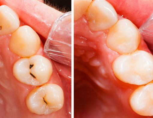 Bisakah Gigi yang Sudah Ditambal Berlubang Kembali?