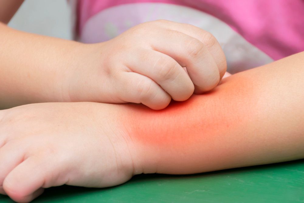Anak Autisme Lebih Rentan Terkena Alergi?