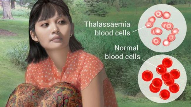 Tak Bisa Disembuhkan, Apa Penyebab Thalassemia?