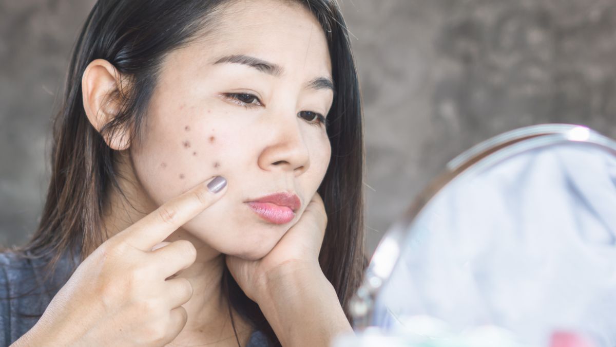 penyebab-jerawat-di-pipi