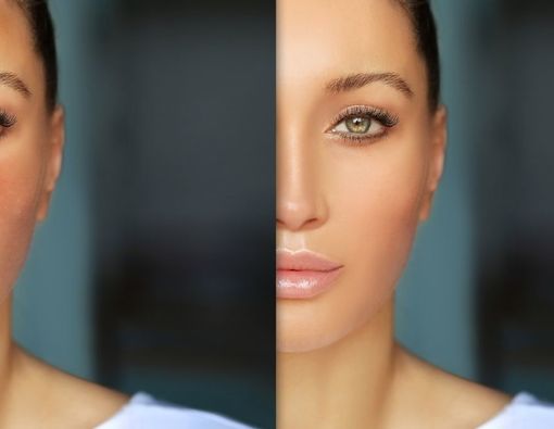 Melasma dan Hiperpigmentasi, Apa Bedanya?