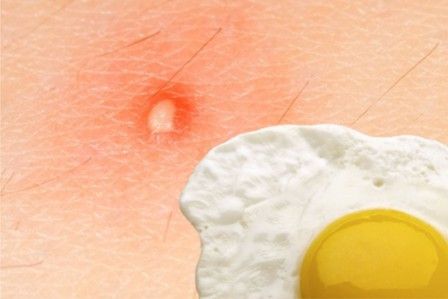 Makan Telur Sebabkan Bisulan Adalah Mitos