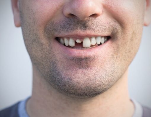 Gigi Depan Patah? Jangan Panik, Begini Solusinya