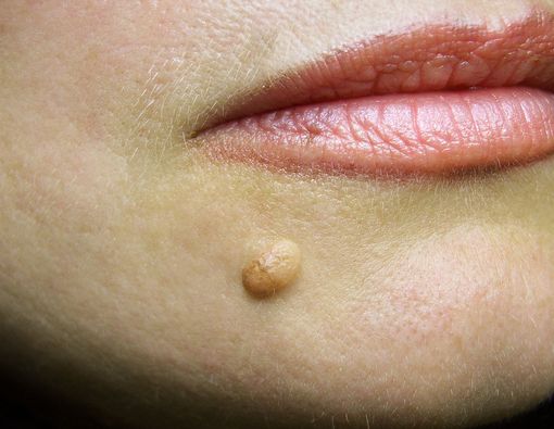 10 Cara Menghilangkan Kutil di Wajah Secara Alami