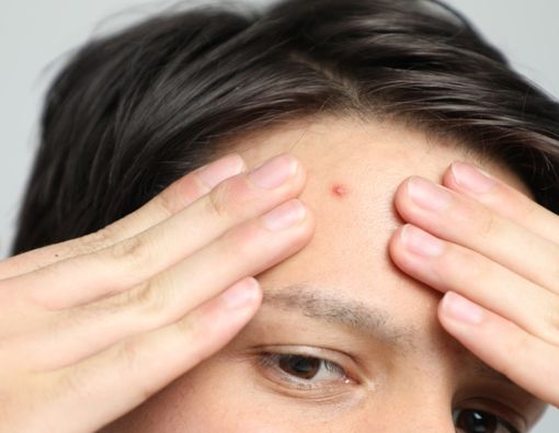 Katanya Masturbasi Bisa Buat Wajah Jadi Jerawatan, Benarkah?