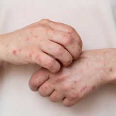 Bahaya Flu Singapura pada Anak Balita yang Sering Diabaikan Orang Tua