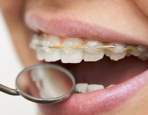 Tips Mengatasi Abrasi Gigi