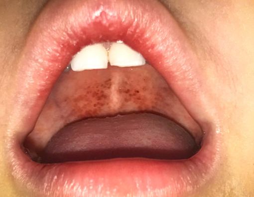 Pasien Difteri Bisa Sembuh, Asal Lakukan 5 Hal Ini