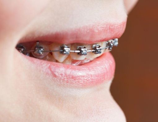 Hati-Hati, Kebiasaan Ini Bisa Bikin Gigi Tonggos