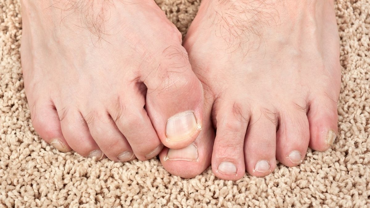 Penyebab Jempol Kaki Bau dan Cara Menghilangkannya