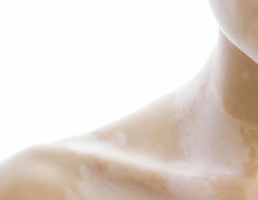 Panu, Penyebab dan Solusinya