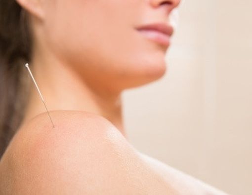 Akupuntur dari Sisi Medis
