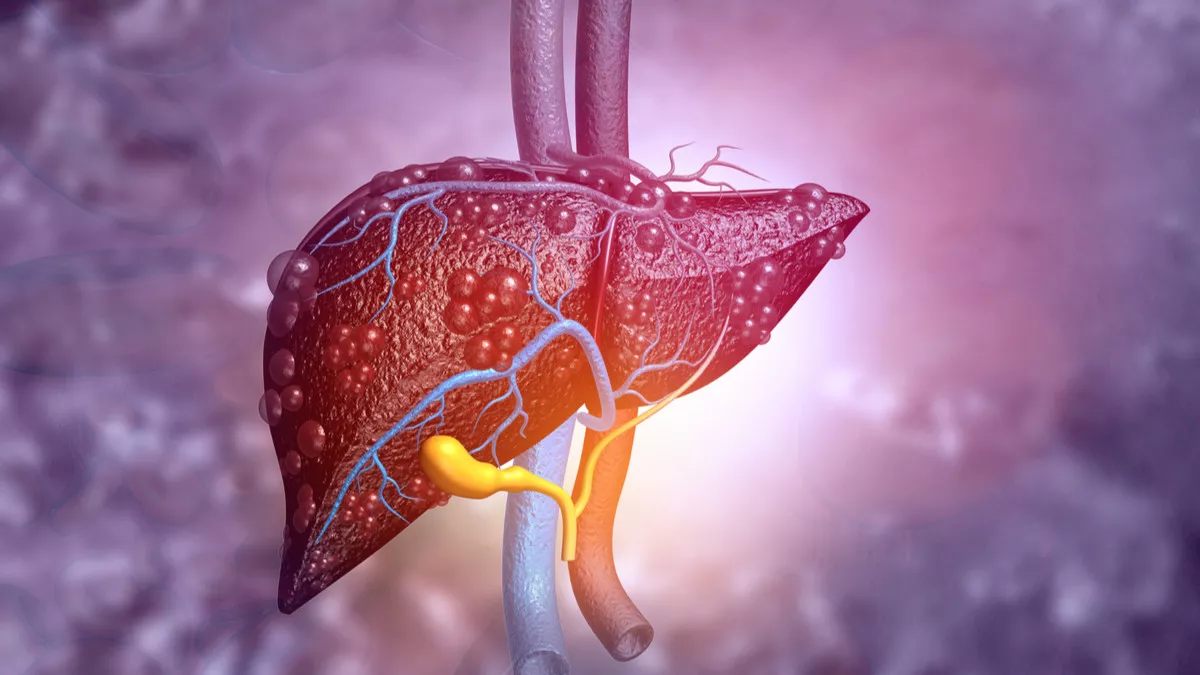 Ilustrasi Fatty Liver atau Perlemakan Hati