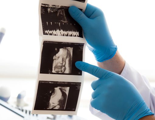 Bumil Perlu Paham, Ini Cara Baca Hasil USG 2 Dimensi