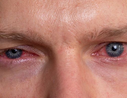 4 Penyakit Mata Penyebab Kebutaan pada Penderita Diabetes