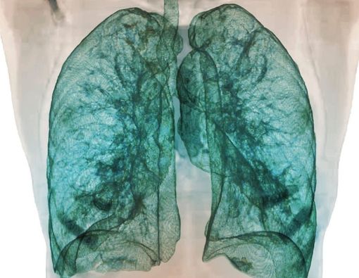 Mengenal Bagian Paru-Paru dan Fungsinya dalam Menunjang Kehidupan