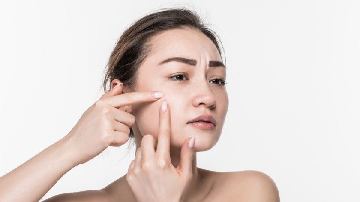Benarkah Jerawat Bisa Menular? Ini Fakta Medisnya