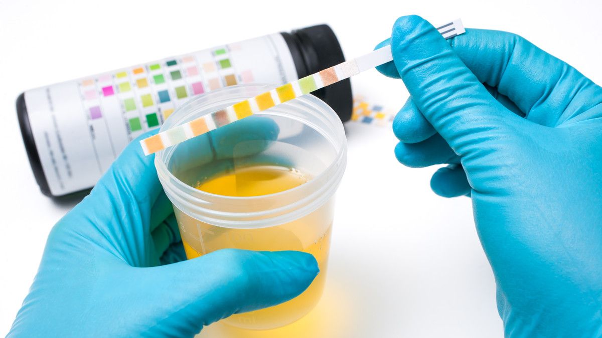 Benarkah Tes Urine Bisa Bantu Diagnosis Kanker Prostat?