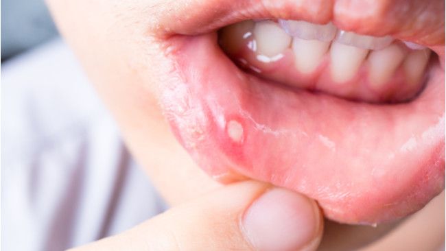 6 Cara Mengobati Sariawan Saat Puasa (Jaksuthep-Teekul/Shutterstock)