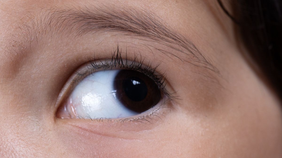 Penyebab dan Cara Mengatasi Nistagmus pada Penglihatan