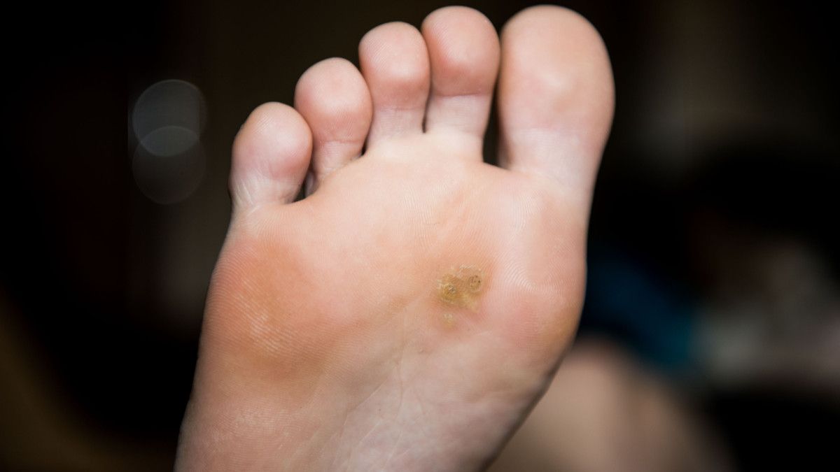 Menghilangkan Mata Ikan di Kaki, Perlukah Dioperasi?