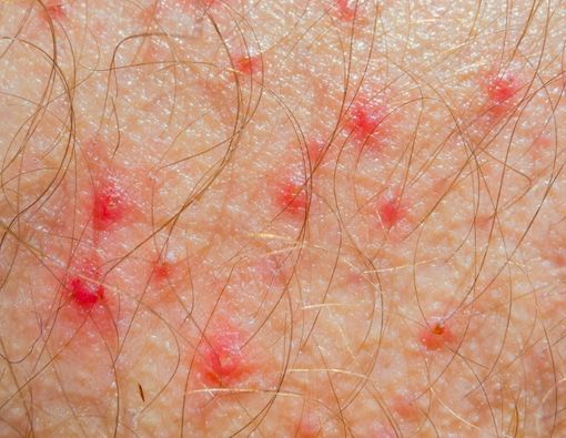 Mengenal Gejala dan Penyebab Psoriasis Gutata
