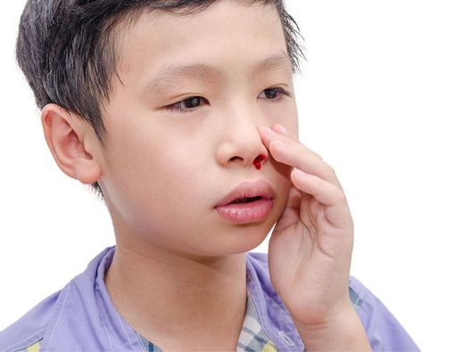 6 Cara Mudah Mengatasi Anak Mimisan