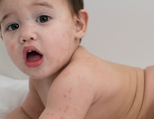 Ciri-ciri dan Gejala Cacar Air pada Bayi
