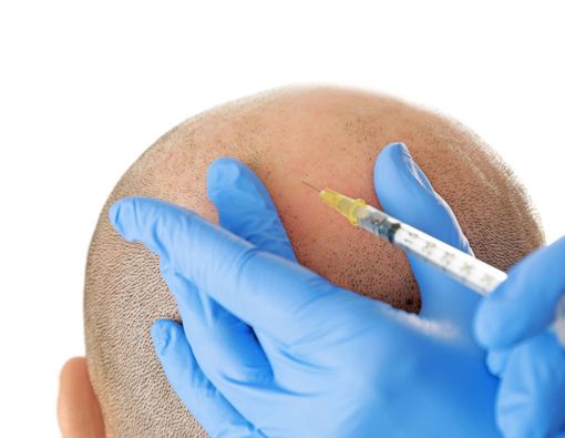 Awas, Obat untuk Rambut Rontok Bisa Picu Disfungsi Ereksi