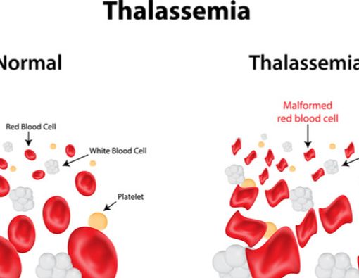 Yuk, Mengenal Thalassemia Lebih Dekat