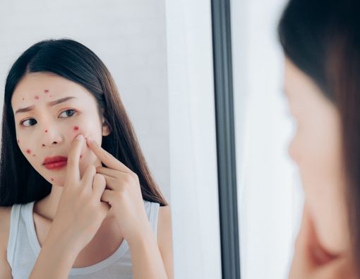 Mitos Tentang Jerawat yang Tak Perlu Dipercaya