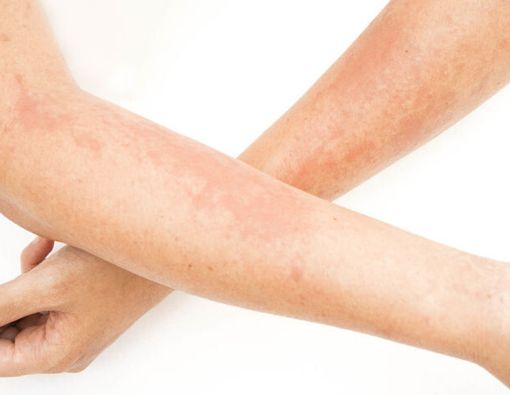 Ini Jenis-jenis Dermatitis Kontak dan Gejalanya