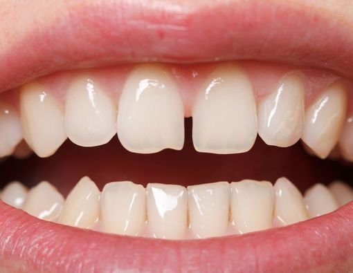 Perlu Tahu, Ini Cara Mengatasi Gigi Bercelah