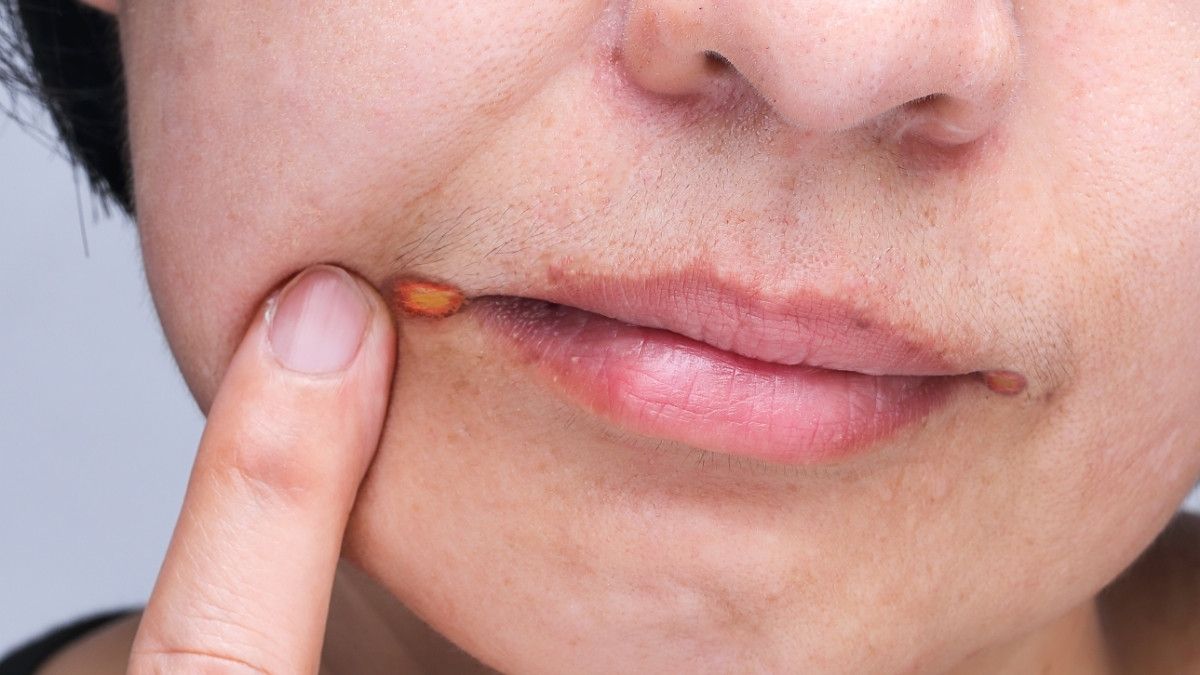 Mengenal Angular Cheilitis, Luka yang Muncul di Sudut Bibir