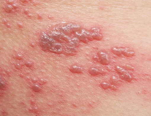 Ternyata, Cacar Api pada Anak Bisa Terjadi Berulang