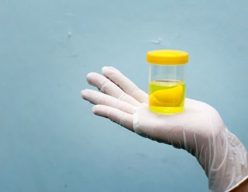 Penyebab Urine Bau Belerang yang Mesti Diketahui