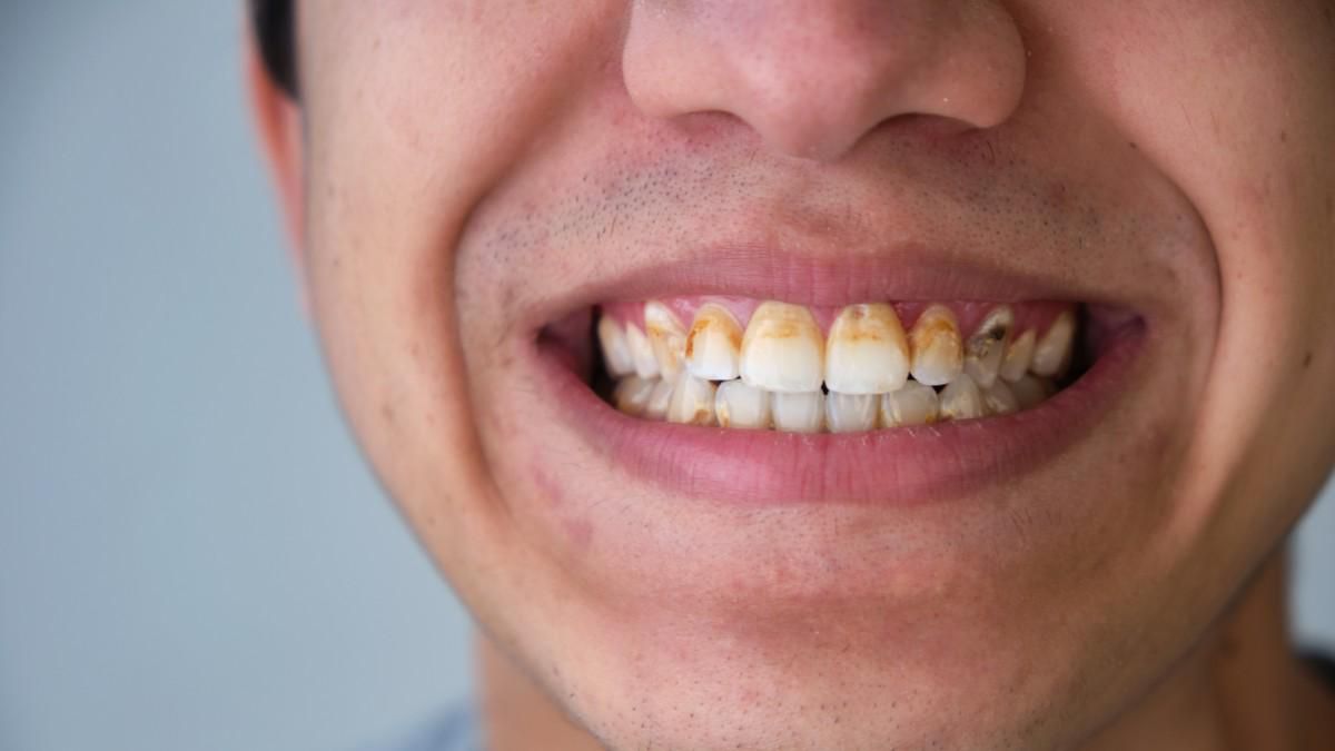 4 Faktor Penyebab Karang Gigi yang Harus Dihindari