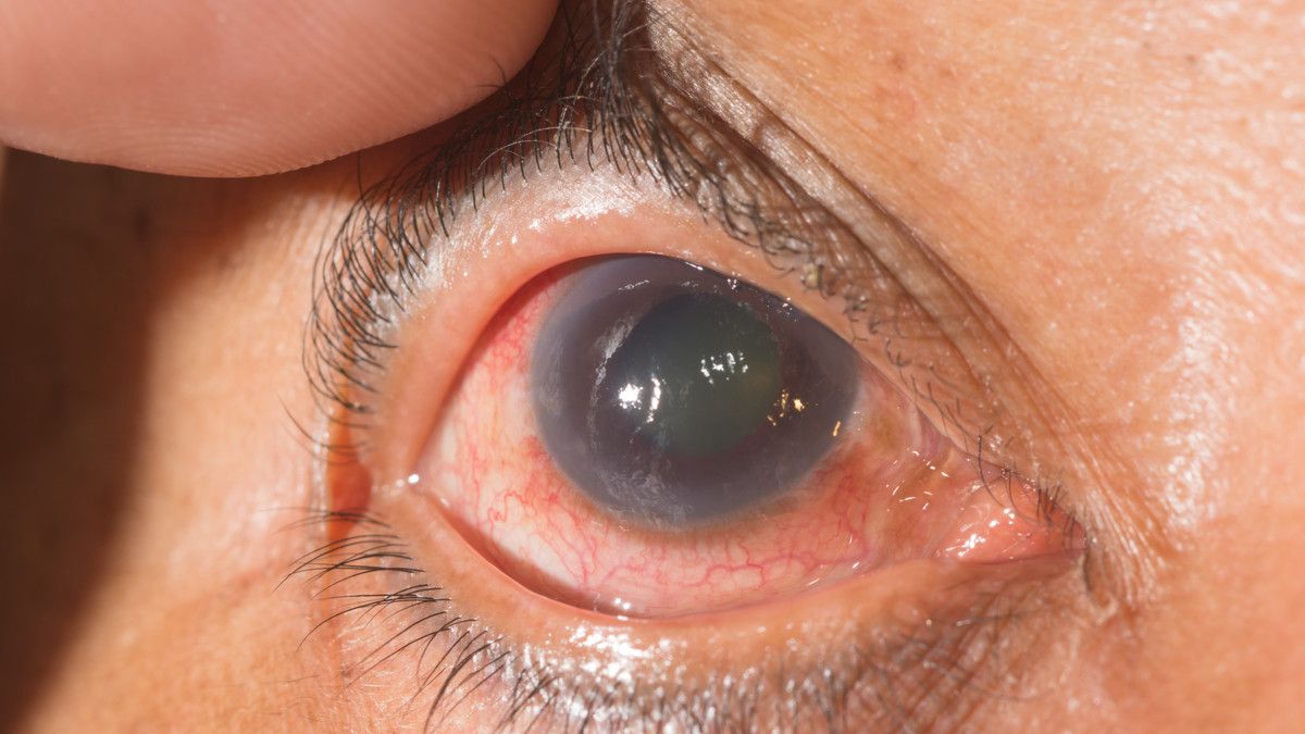 Mengenal Kondisi Glaukoma yang Bisa Sebabkan Kebutaan