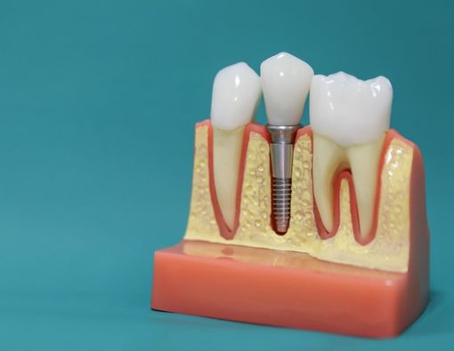 Bolehkah Penderita Osteoporosis Implan Gigi? Ini Kata Dokter