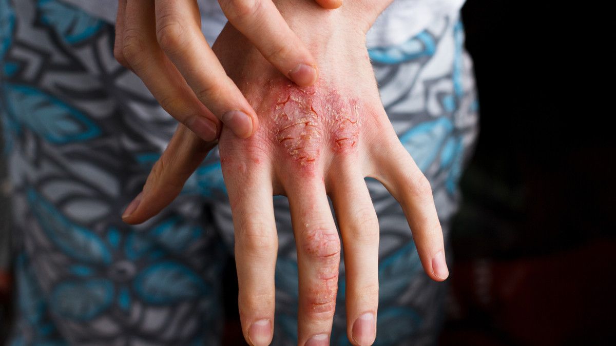 8 Pilihan Obat Dermatitis Atopik Sesuai Kondisi Kulit