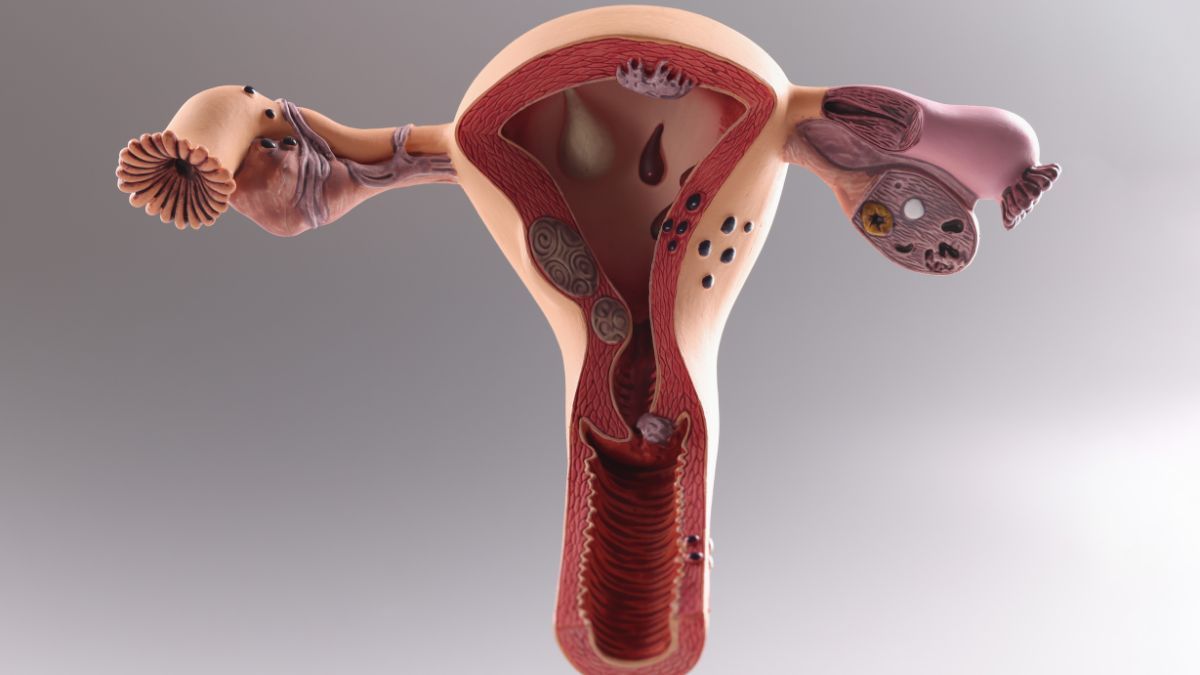 Mengenal 7 Jenis Operasi Miom yang Perlu Diketahui